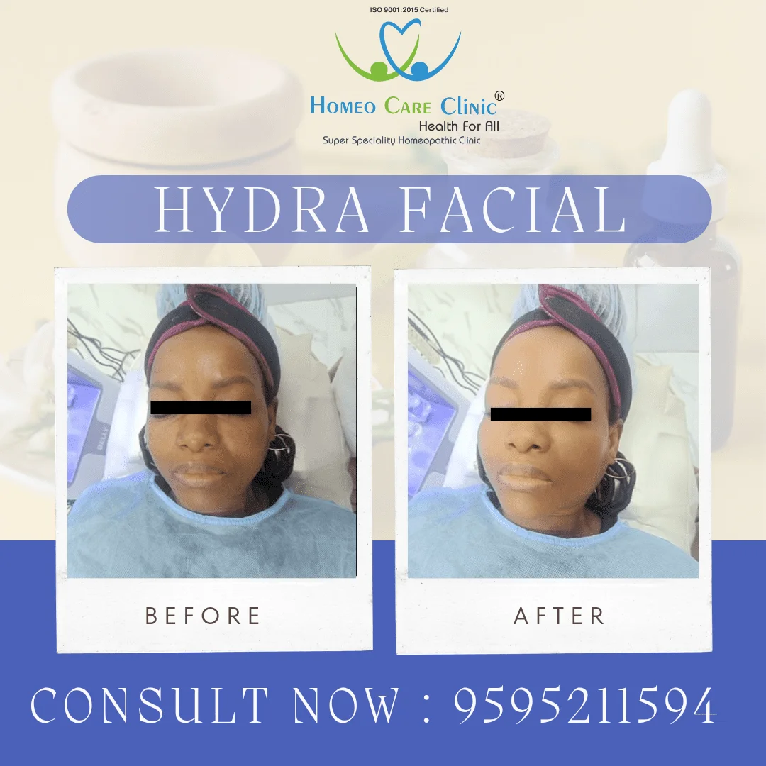 Hydra-Facial-for-Anti-Aging-