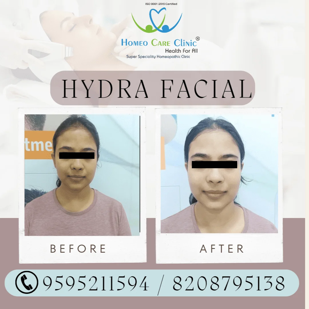 Hydra-facial-for-Acne-Marks